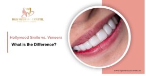 What is the difference between Hollywood smile and dental veneers