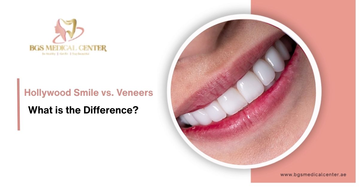 What is the difference between Hollywood smile and dental veneers