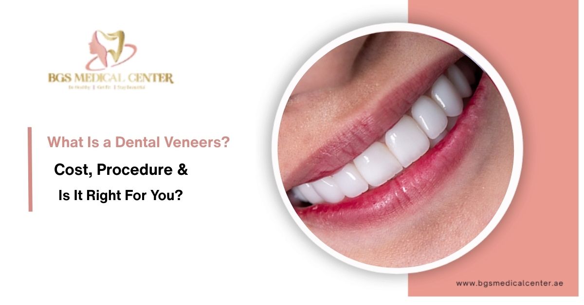 What are Dental veneers? Who is it for?