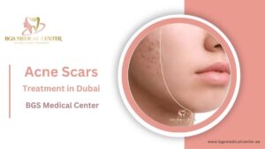 Acne Scars Treatment Dubai: Clear Skin Laser, Microneedling & PRP Options