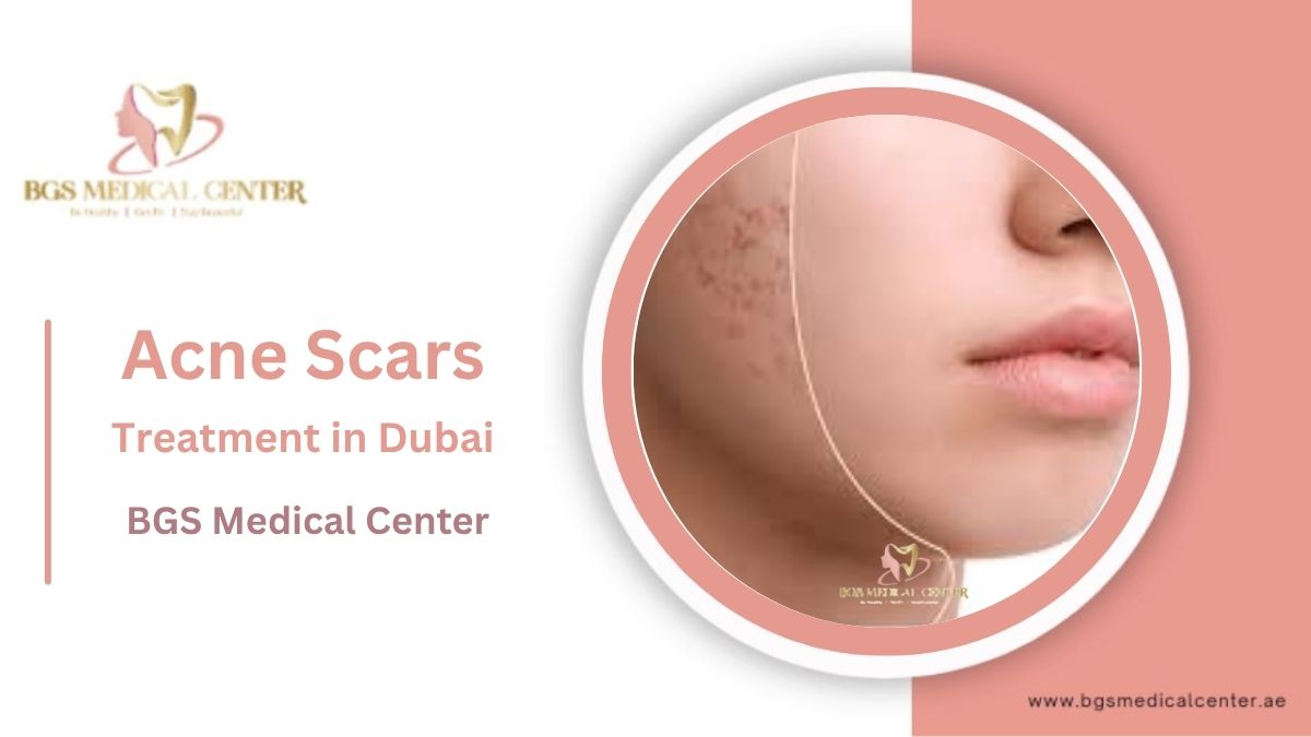 Acne Scars Treatment Dubai: Clear Skin Laser, Microneedling & PRP Options
