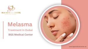 BGS Clinic offers the best Melasma treatment in Dubai’s climate