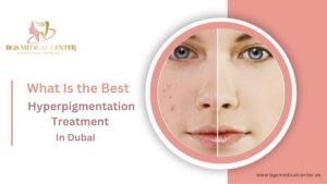 BGS medical center provides best hyperpigmentation treatment in Dubai.