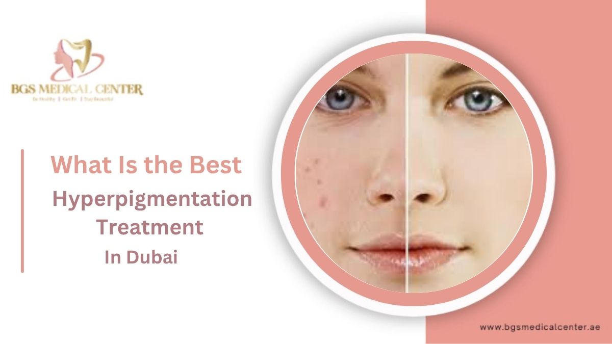 BGS medical center provides best hyperpigmentation treatment in Dubai.